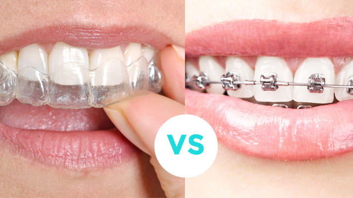 Should I get Invisalign or regular braces?