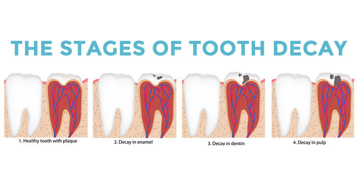 How fast can a tooth decay?