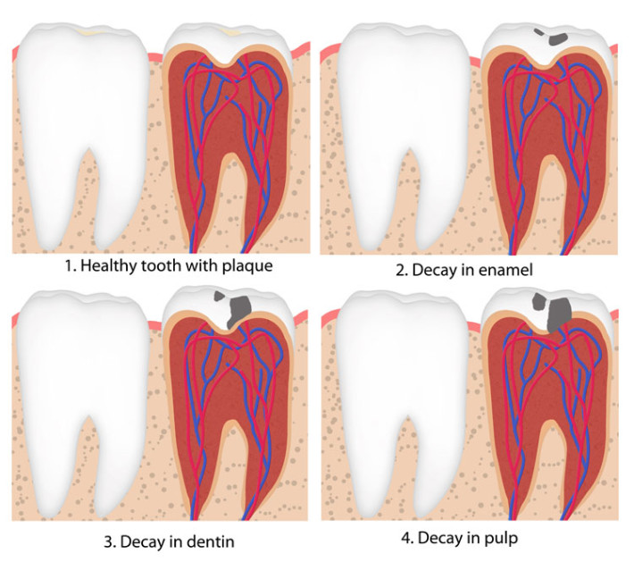 how fast can tooth decay diagram