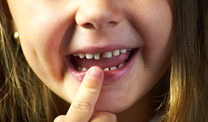How fast can a tooth decay?