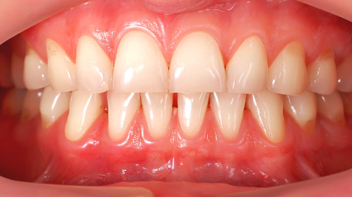 Receding gums causes, prevention and treatments