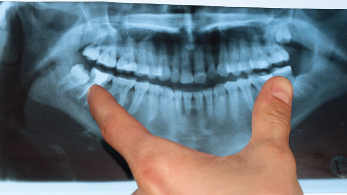 When is it necessary to remove wisdom teeth?