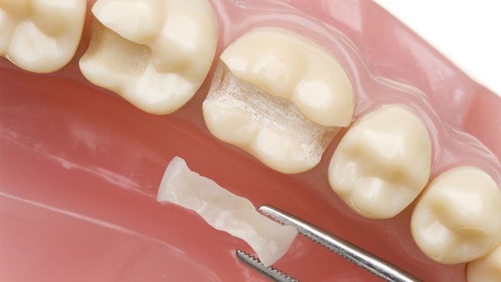 When You Need Onlays, What Is The Best Filling Material for Your Teeth?