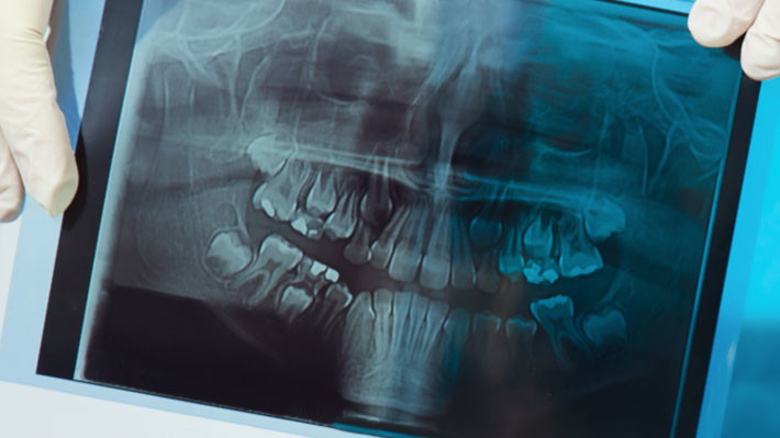 Supernumerary Teeth: Their Causes and Solutions