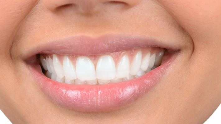 Why Professional Whitening is Superior to At-Home Solutions