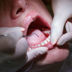 Identifying the Early Signs of Gum Disease