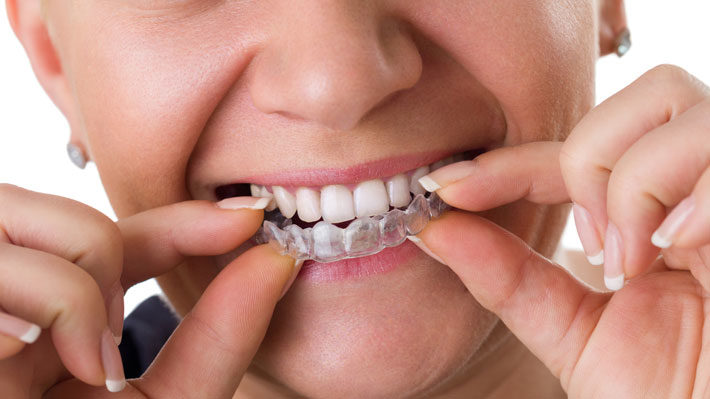 Top Benefits You’ll Enjoy with Invisalign Braces