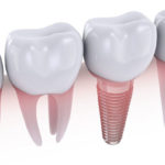 Dental Implant Facts You Need to Know