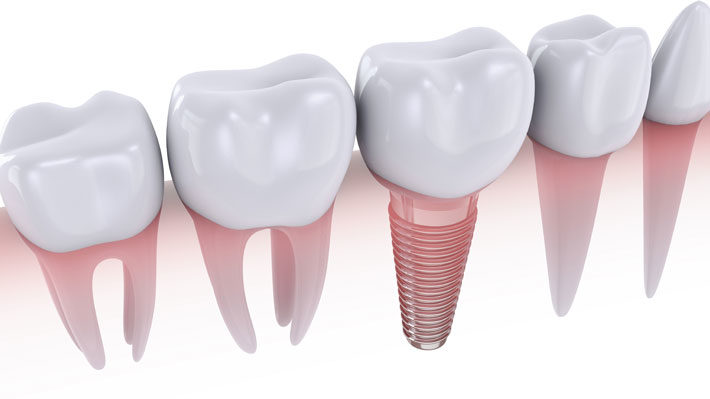 Dental Implant Facts You Need to Know