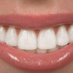 Why Get a Smile Makeover? The Survey Says…