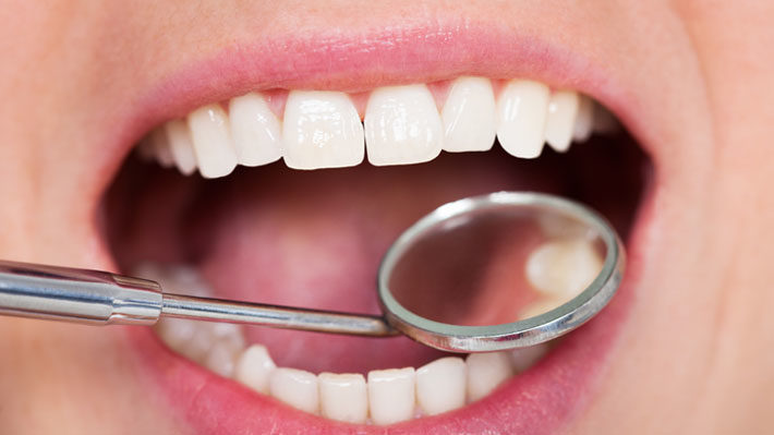 Are White Fillings as Reliable as Silver Fillings?