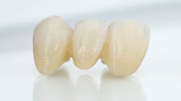 The Pros and Cons of Dental Bridges