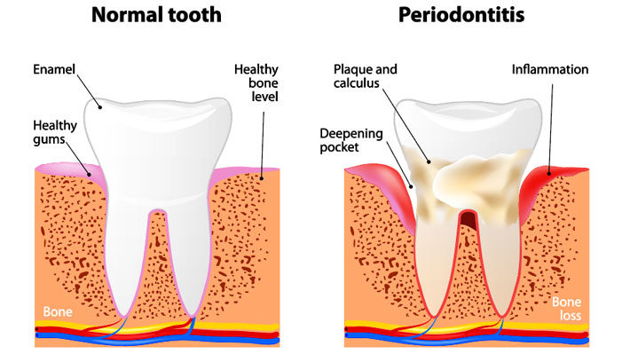 Six Early Warning Signs of Gum Disease