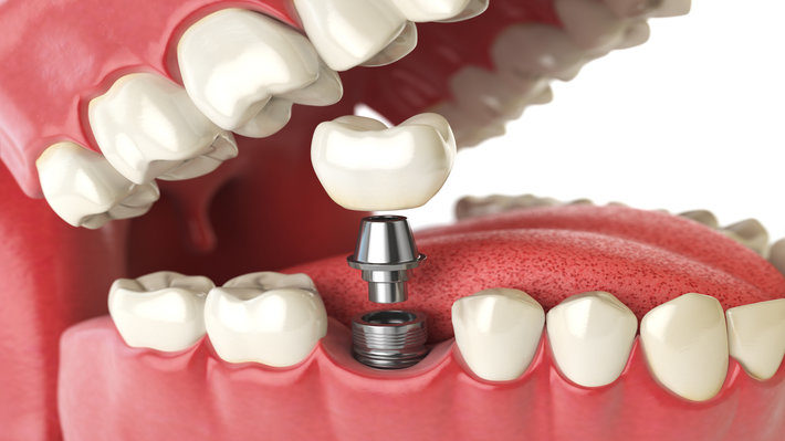 Relax: Why You Shouldn’t Fear Your Dental Implant Surgery
