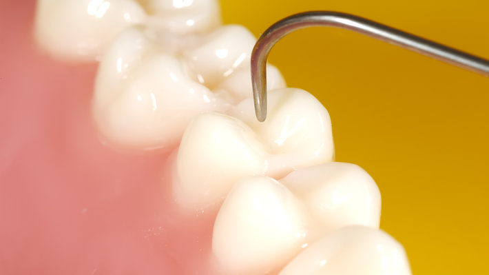 What Factors are Putting You at Greater Risk for Cavities?