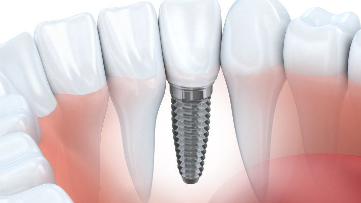 Answers to Common Dental Implant Questions