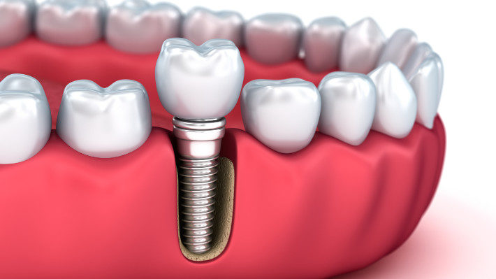 Dental Implants: How They’ll Change Your Life