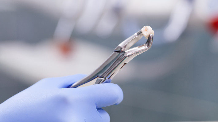 Preparing for a Tooth Extraction
