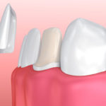 Are You a Candidate for Porcelain Veneers?