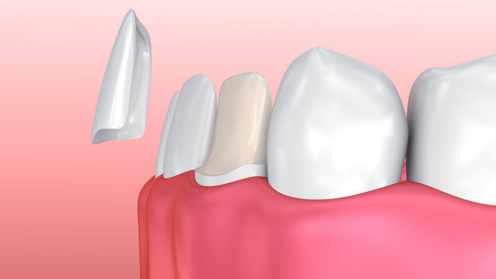 Are You a Candidate for Porcelain Veneers?