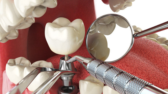 A Brief Guide to Dental Implants