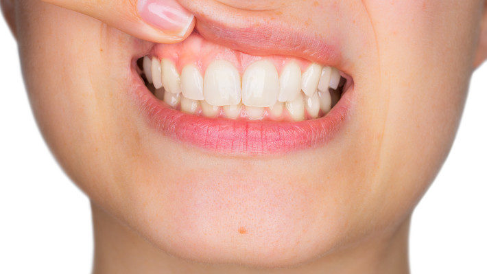 Are Your Bleeding Gums a Sign of Gum Disease?