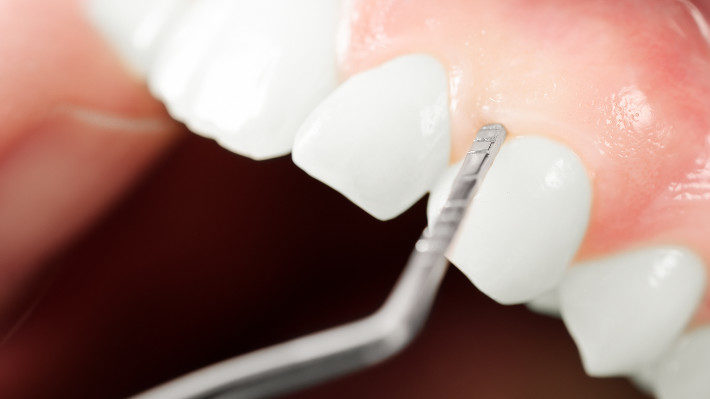 Four Signs that Your Gums Might Be Receding