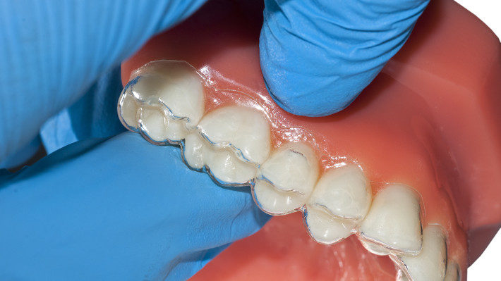 Invisalign and Smile Perfection