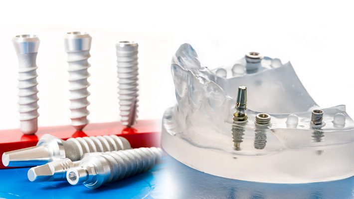 Important Answers to Six Common Dental Implant Questions