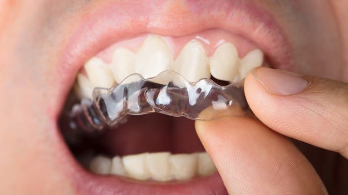 Invisalign: The Right Choice for Your Adult Braces Needs